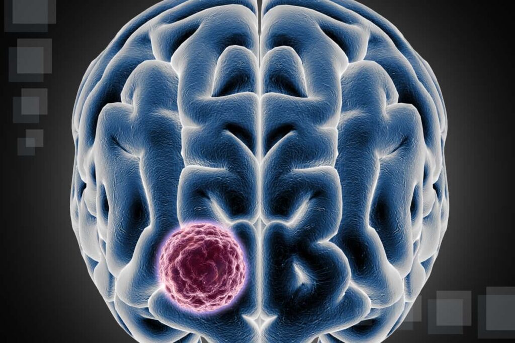 Brain Tumor Lone Star Neurology