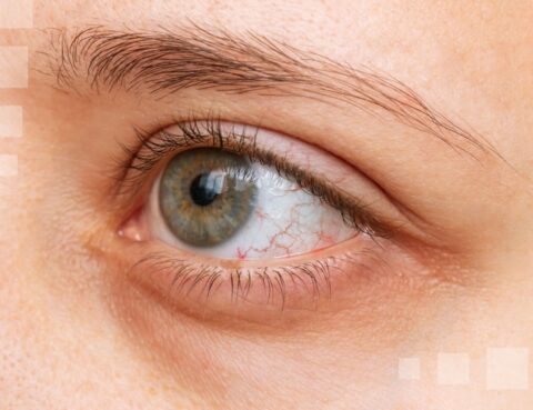 burst blood vessel in the eye