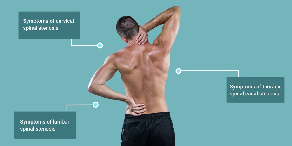 Six Signs of Spinal Stenosis