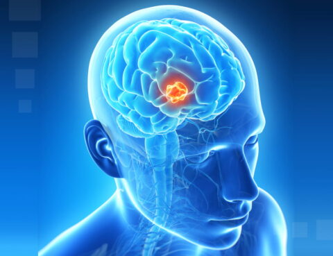 Balo Disease