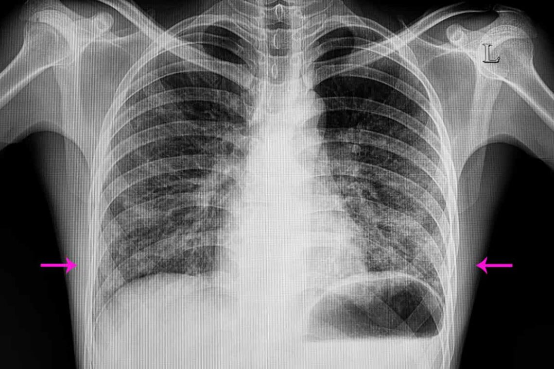 Bilateral Pneumonia
