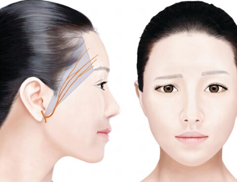 Myasthenia Gravis