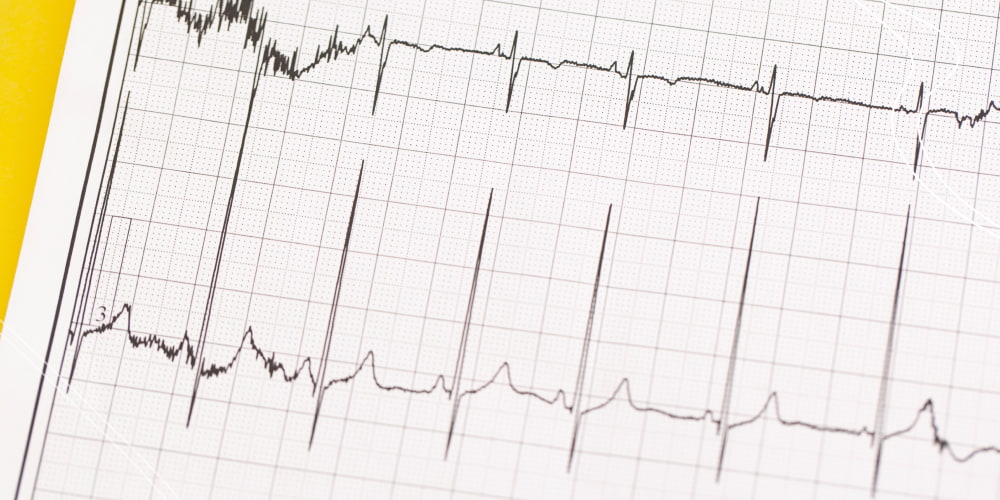 wolf parkinson syndrome ablation