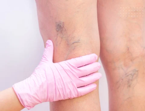 varicose veins