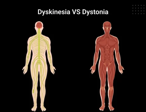 Difference Between Dyskinesia and Dystonia