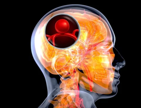 What is a Brain Aneurysm