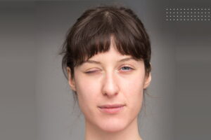 Hemifacial spasm diagnosis and treatment