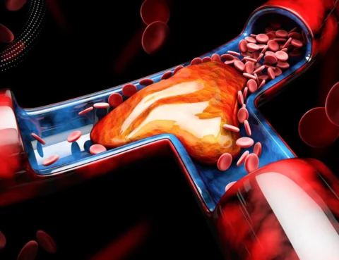 What are the Risk Factors for DVT?