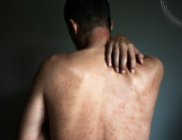 Tubular Sclerosis Complex