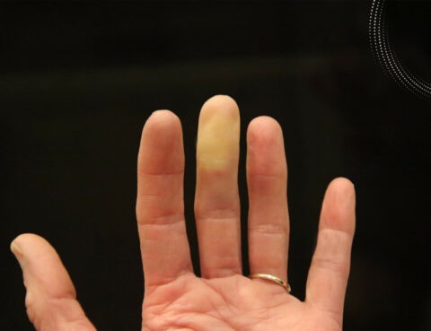 Raynaud disease treatment