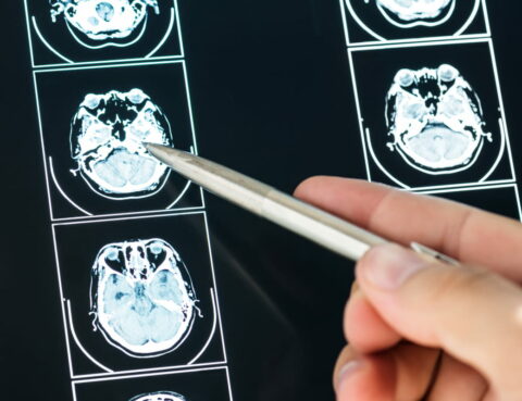 tuberous sclerosis treatment