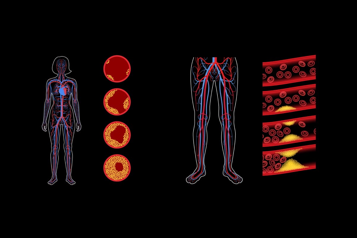 Peripheral Vascular Disease vs. Peripheral Arterial Disease