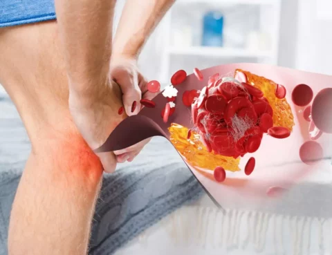 pad-and-raynauds-disease