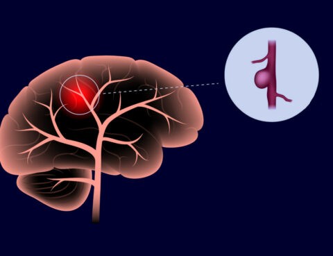 Diagram showing a side view of a human brain with indicating a brain aneurysm