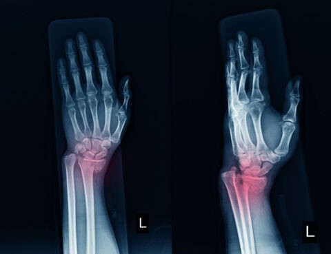 Fracture-of-the-radius-of-the-wrist