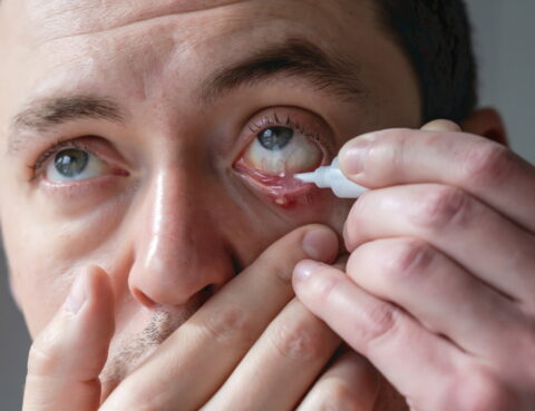 How-to-Treat-Stye-on-the-Eye