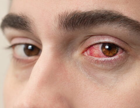What-is-conjunctivitis
