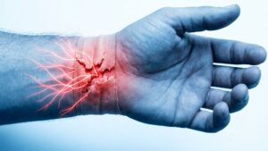 Complex-Regional-Pain-Syndrome
