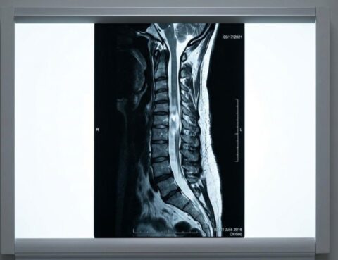 Transverse-Myelitis_-Sudden-Spinal